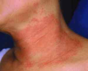 Atopowe zapalenie skóry (AZS) - Biedronkowo